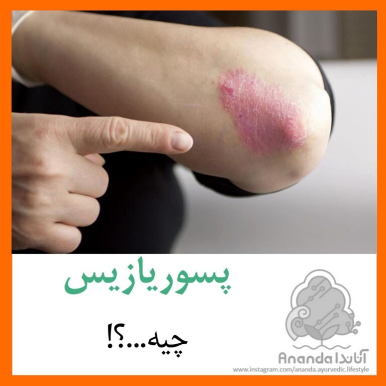 پسوریازیس