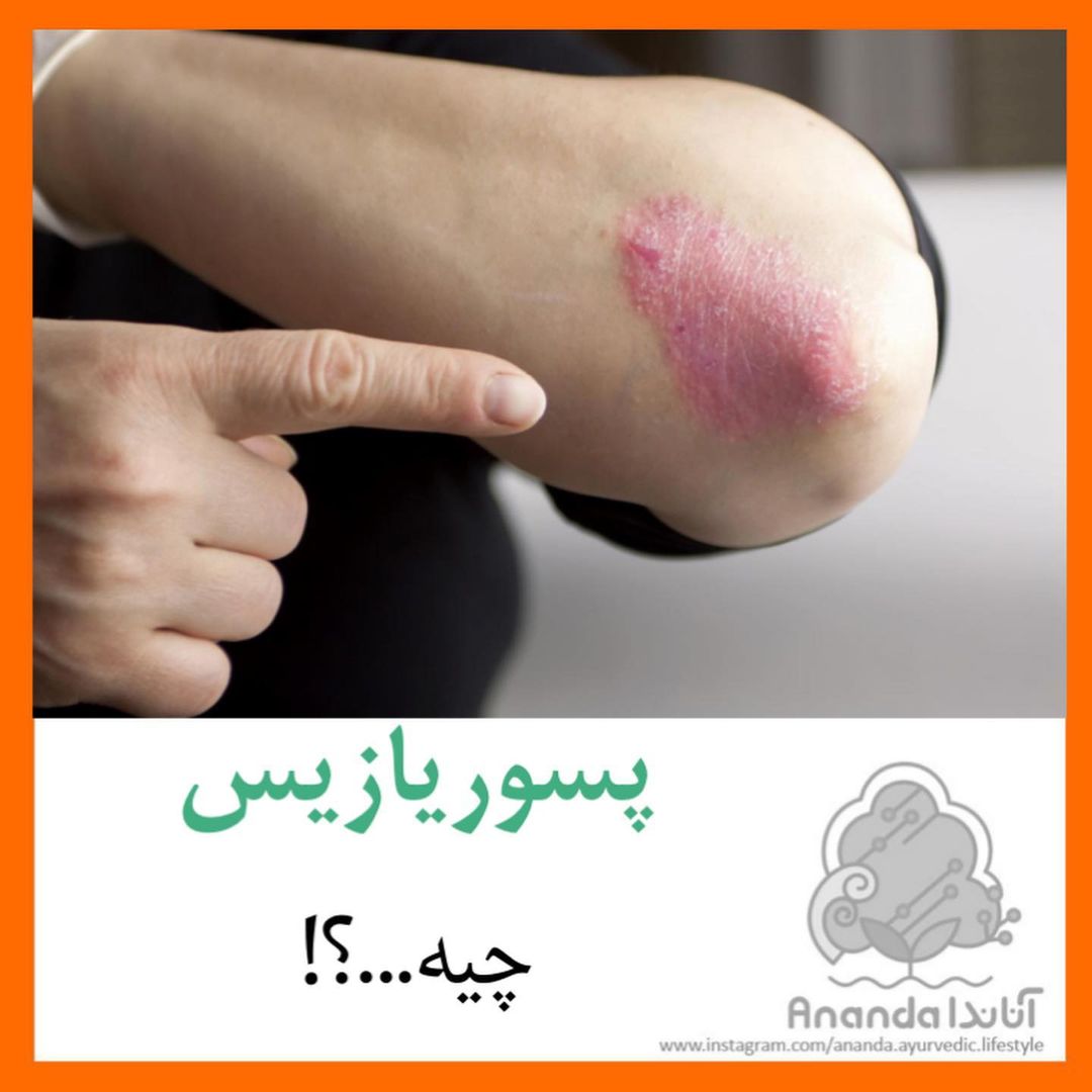 پسوریازیس